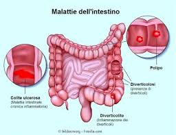 malattie-colon